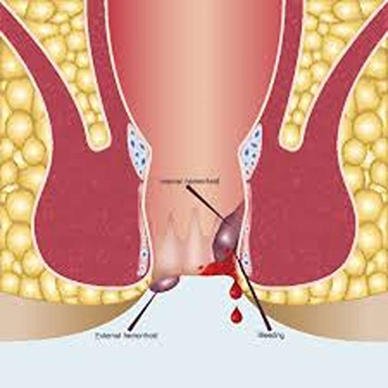 Pilonidal Sinus Treatment Center in Trichy malakar ayur care  main image