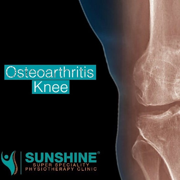 knee osteoarthritis (OA) and how it’s typically treated at Sunshine Clinic main image