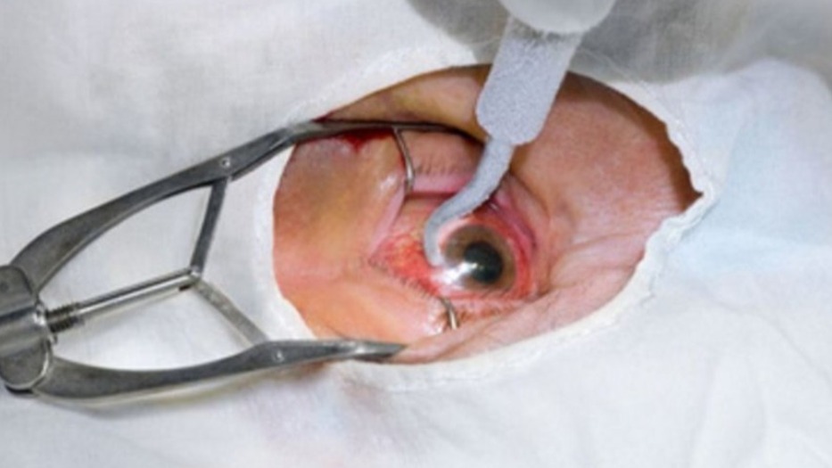 Phacoemulsification in Nagpur for Modern Cataract Removal main image