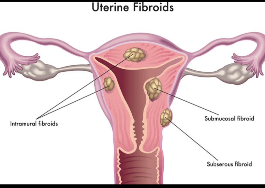 Fibroid Uterus Treatment in Nagpur – Minimally Invasive Solutions main image