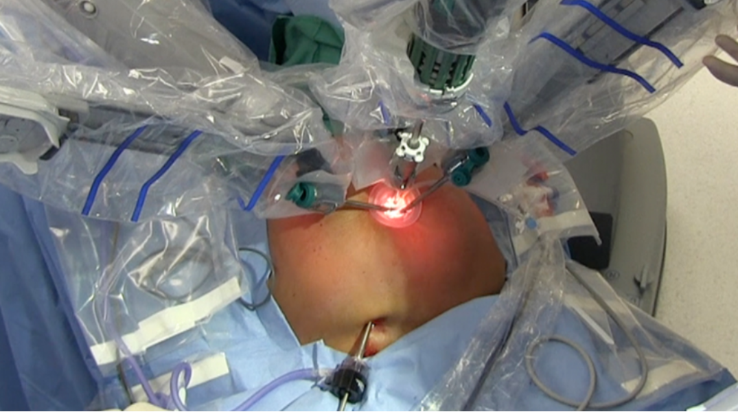 Robotic Rectal Cancer Surgery in Nelamangala – A Precise Approach to Colorectal Treatment main image