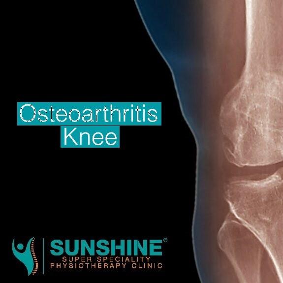Osteoarthritis (OA) of the knee treatment as provided at Sunshine Super Speciality Physiotherapy Cli main image