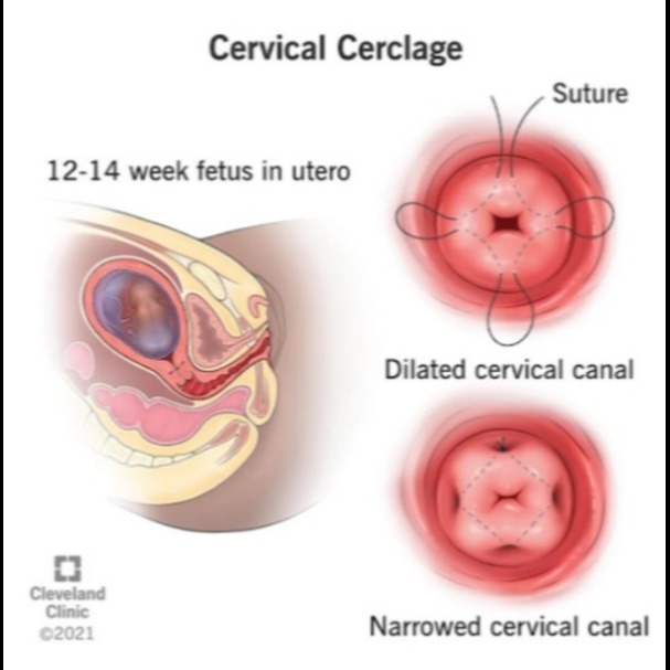 Cervical Cerclage in Nagpur – Ensuring Safe Pregnancy Outcomes main image