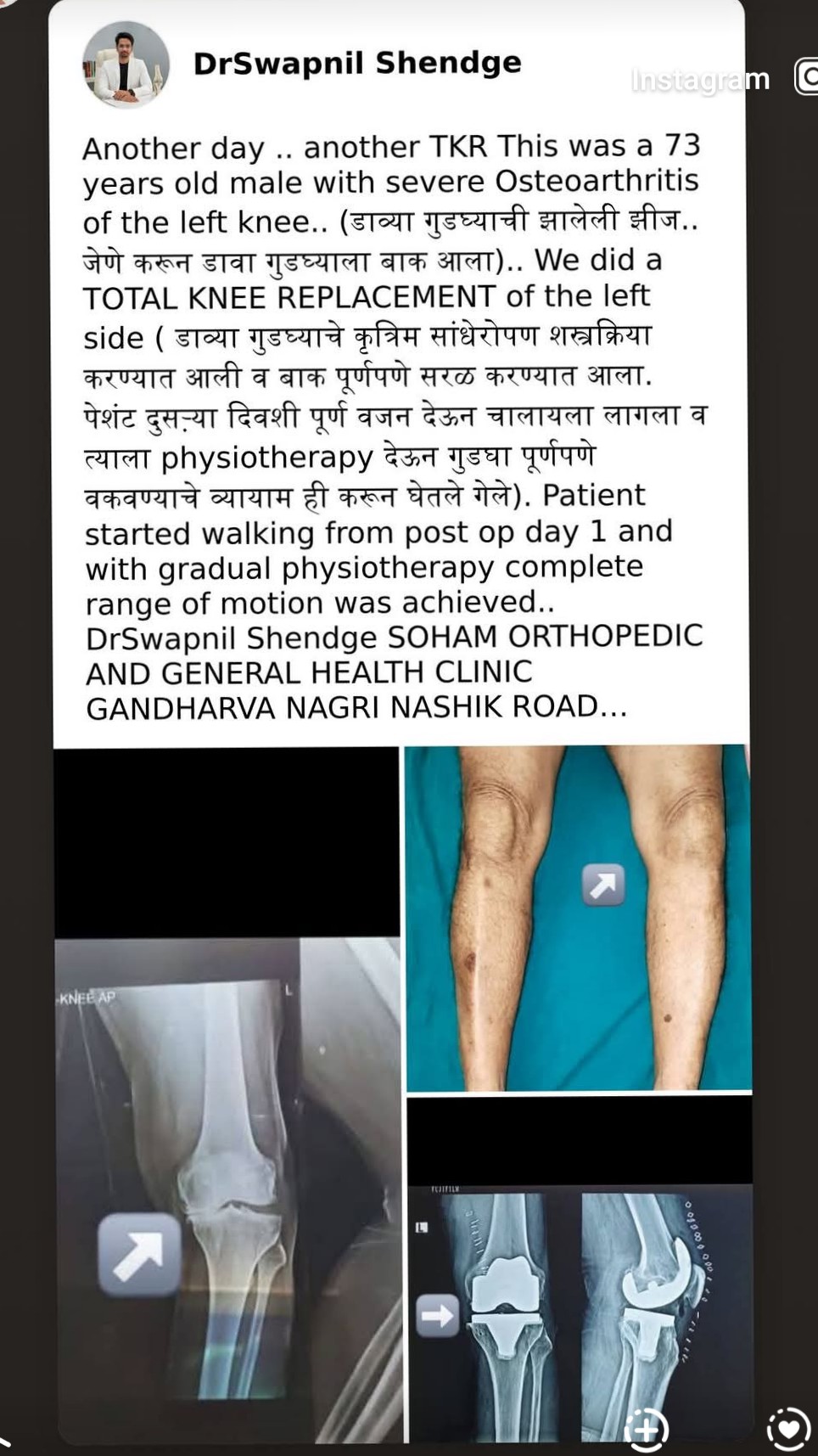 Another successful knee replacement surgery done by our surgeon Dr Swapnil Shendge sir  main image