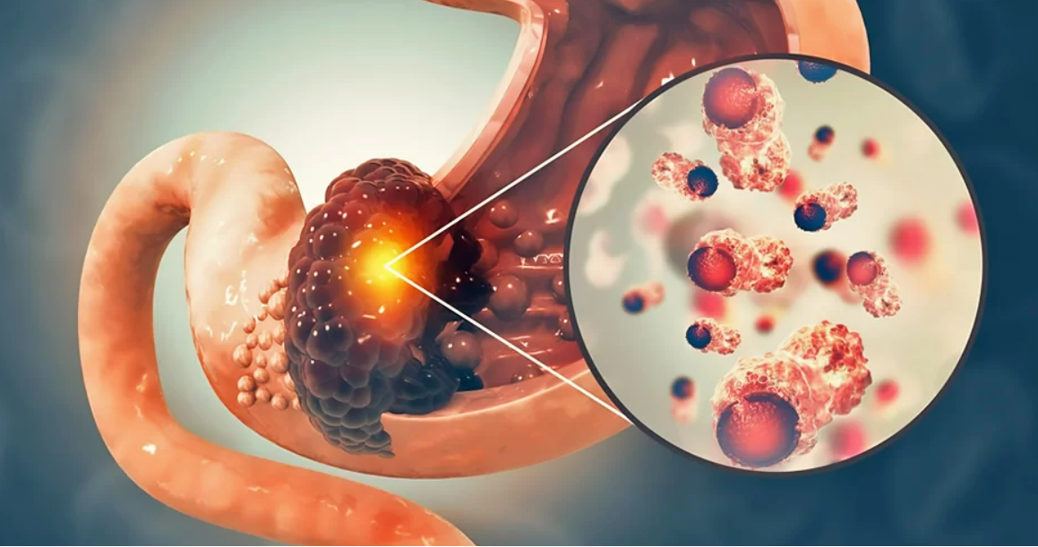 Gastric Cancer Doctor In South Delhi | Dr Sandeep Jha DNB (Surgical  Gastro), MS - Delhi