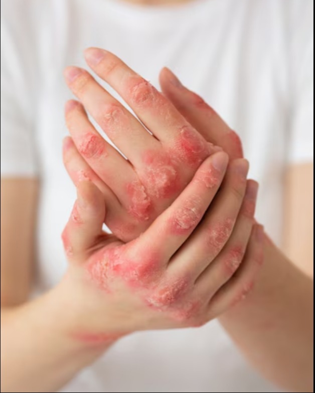 Ayurvedic Medicine for Eczema in Pune – Gentle Healing for Sensitive Skin main image