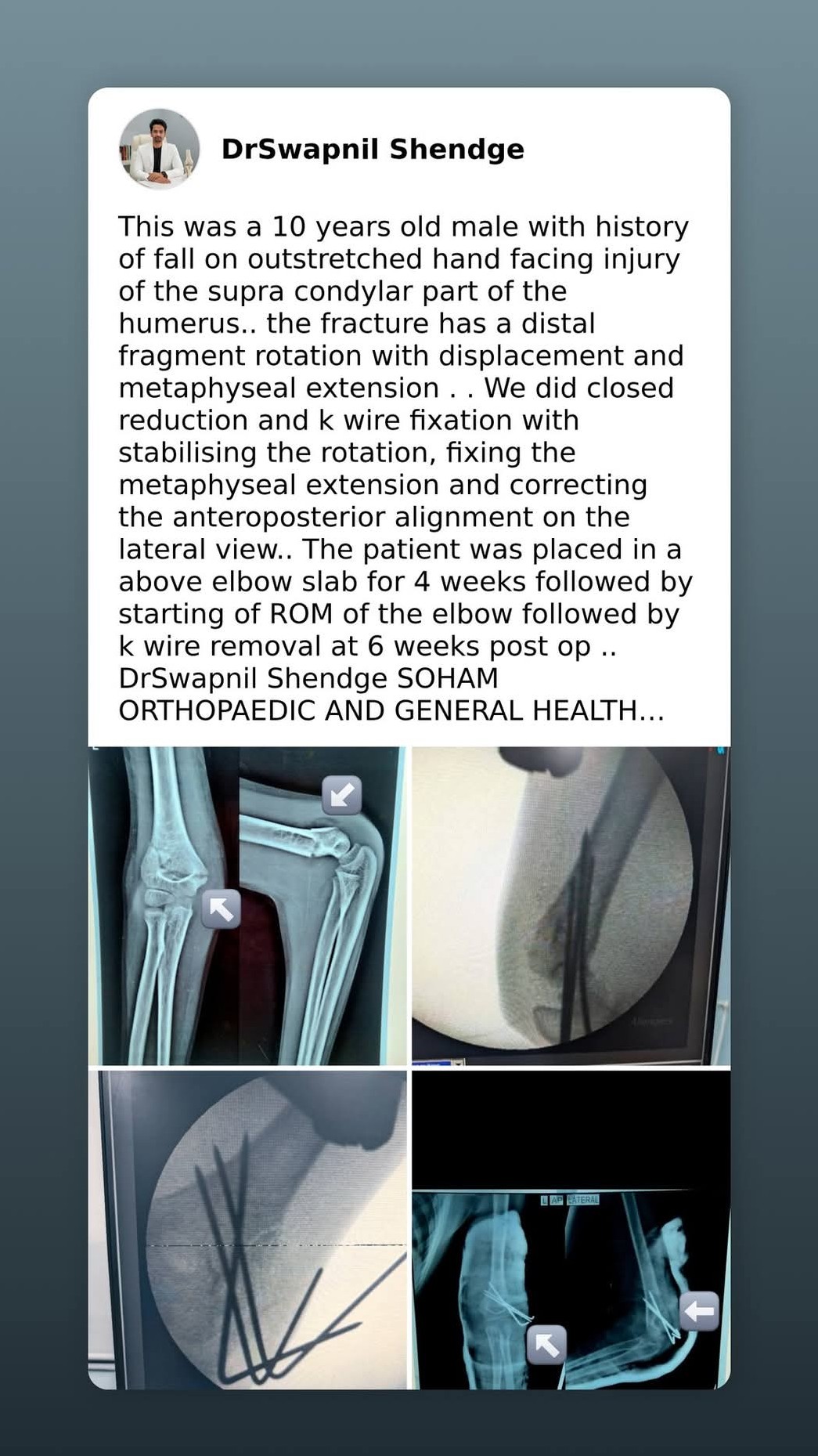 A recent orthopedic accident case operated by our surgeon Dr Swapnil Shendge sir..   #Nashikorthoped... main image