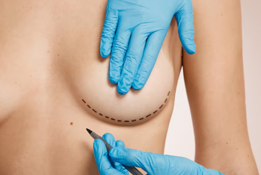 Breast Surgery in Ambattur - Expert Care for Breast Health main image