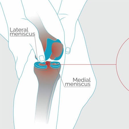Osteoarthritis knee and physiotherapy treatment at Sunshine Clinic main image