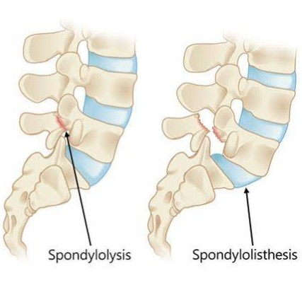 Lumbar disc listhesis, commonly referred to as spondylolisthesis treatment at Sunshine Clinic main image