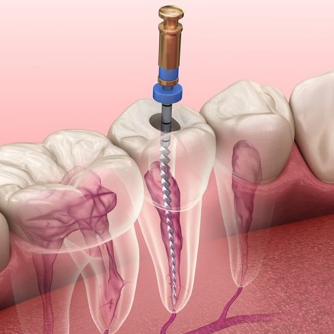 Painless Root Canal Treatment near me in Bandra / Mahim main image
