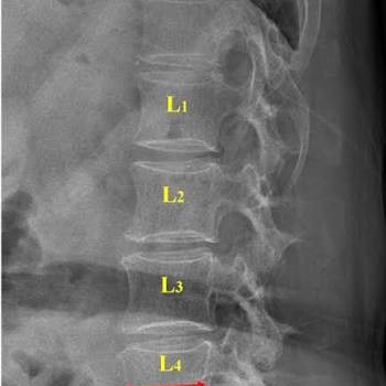 Degenerative Disc, and Physiotherapy Treatment at Sunshine Super Speciality Physiotherapy Clinic main image
