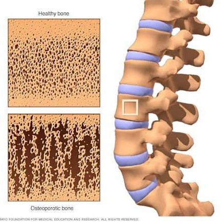 Osteoporosis treatment at Sunshine Clinic main image