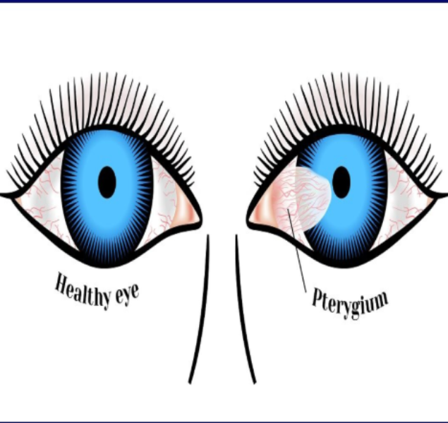 Pterygium Treatment in Nagpur main image