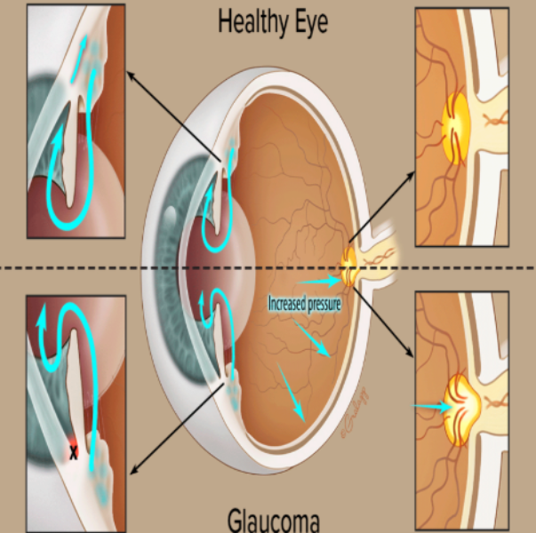 Glaucoma Management in Nagpur main image