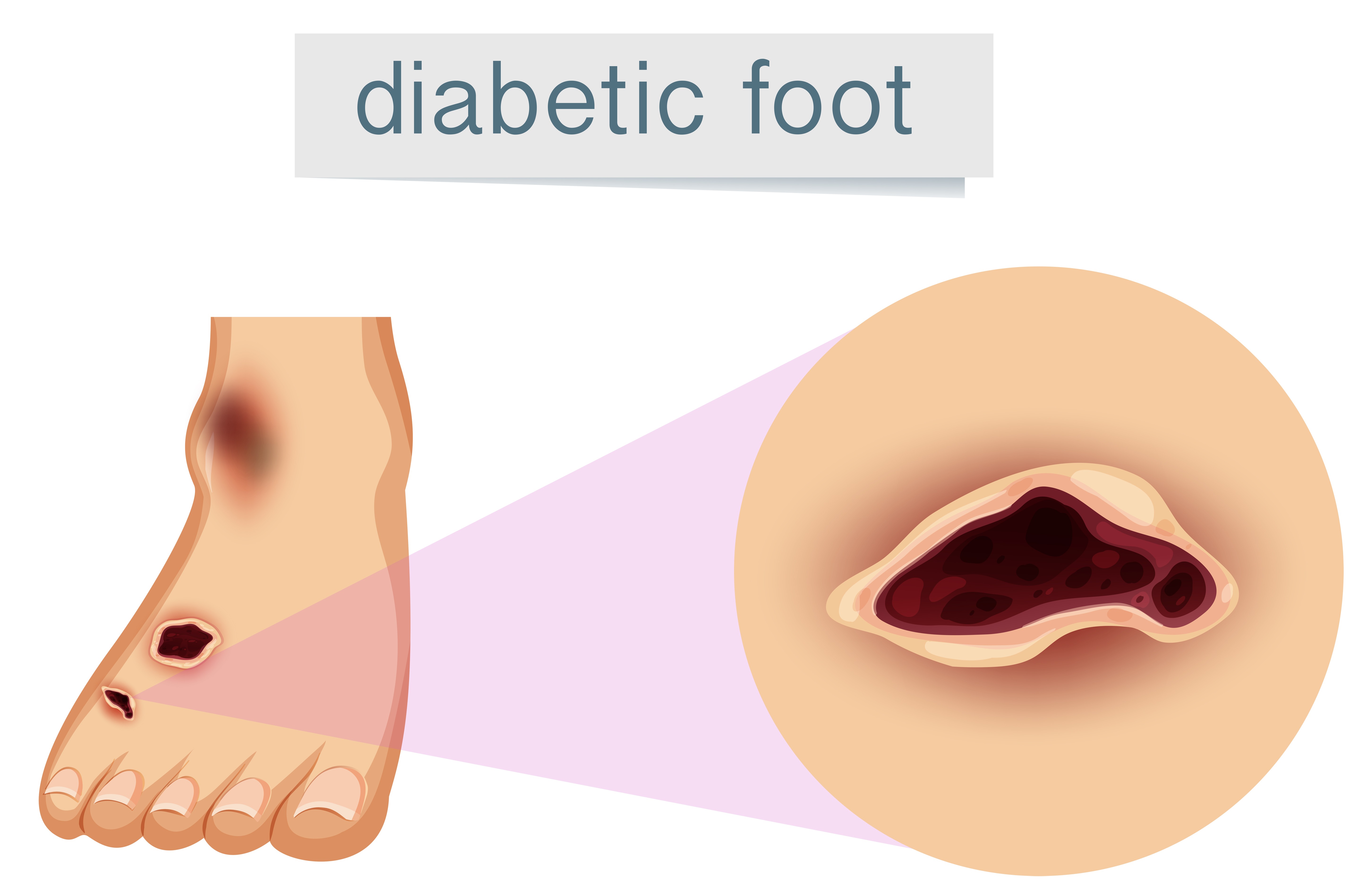 Diabetic foot care in Bangalore – Protecting Every Step You Take main image