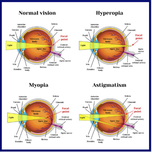 Refractive Error Correction in Nagpur main image