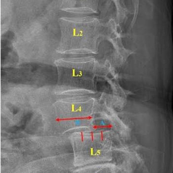 Low Back Pain and Physiotherapy Treatment at Sunshine Super Speciality Physiotherapy Clinic, main image
