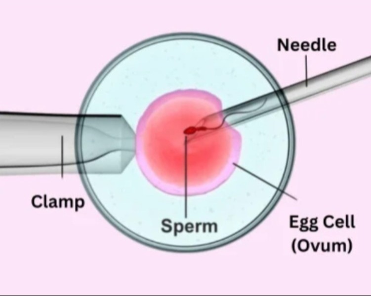 ICSI Treatment in Chennai – Advanced Fertilization Support for Severe Male Factor Cases main image