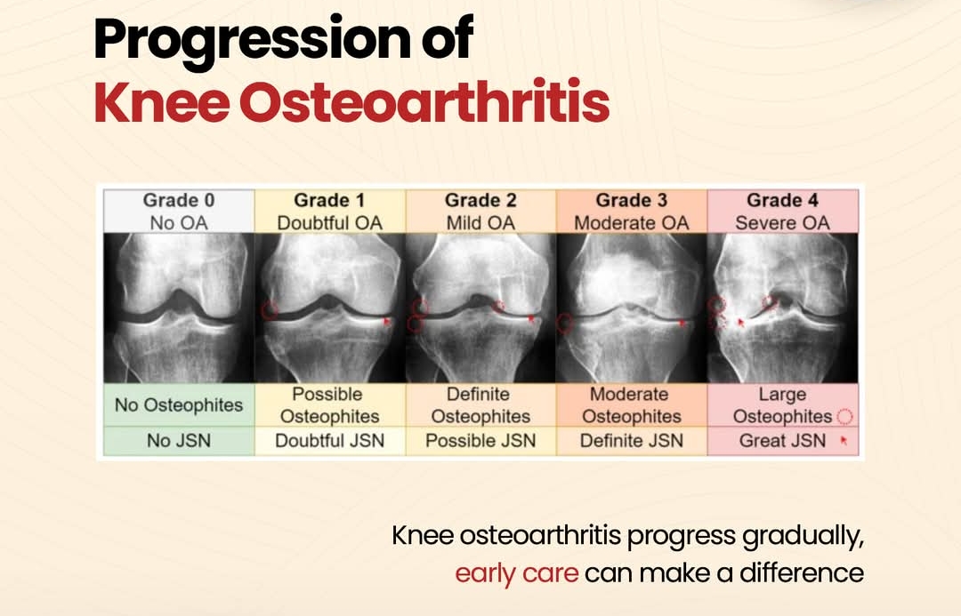 Knee osteoarthritis treatment at Sunshine Clinic main image