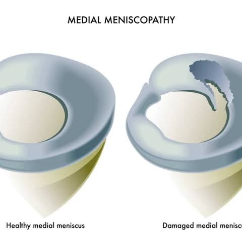 Degenerative meniscal tears must be treated at Sunshine Super Speciality Physiotherapy Clinic main image