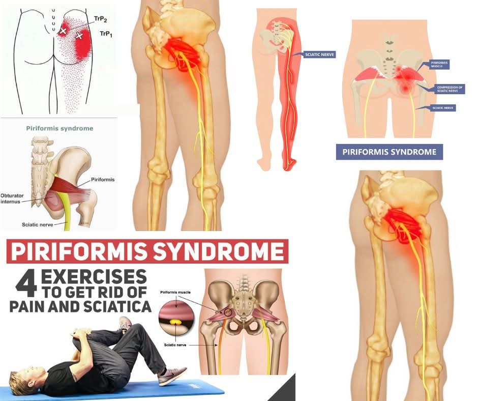 low back pain treatment at Sunshine Super Speciality Physiotherapy Clinic main image