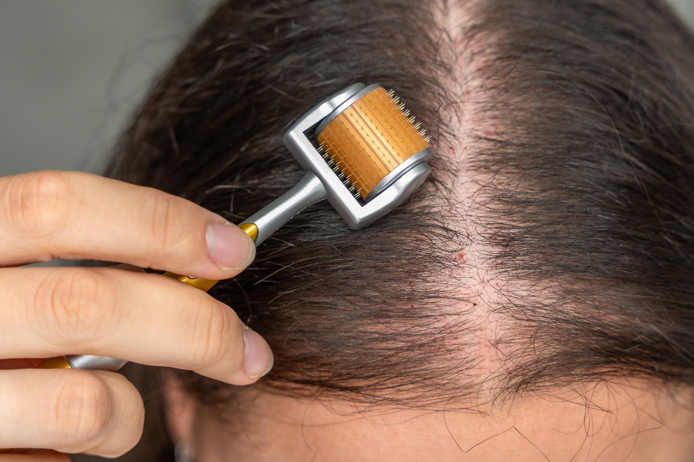 Hair Microneedling and Dermaroller Therapy in Chennai – Supporting Hair Growth Naturally main image