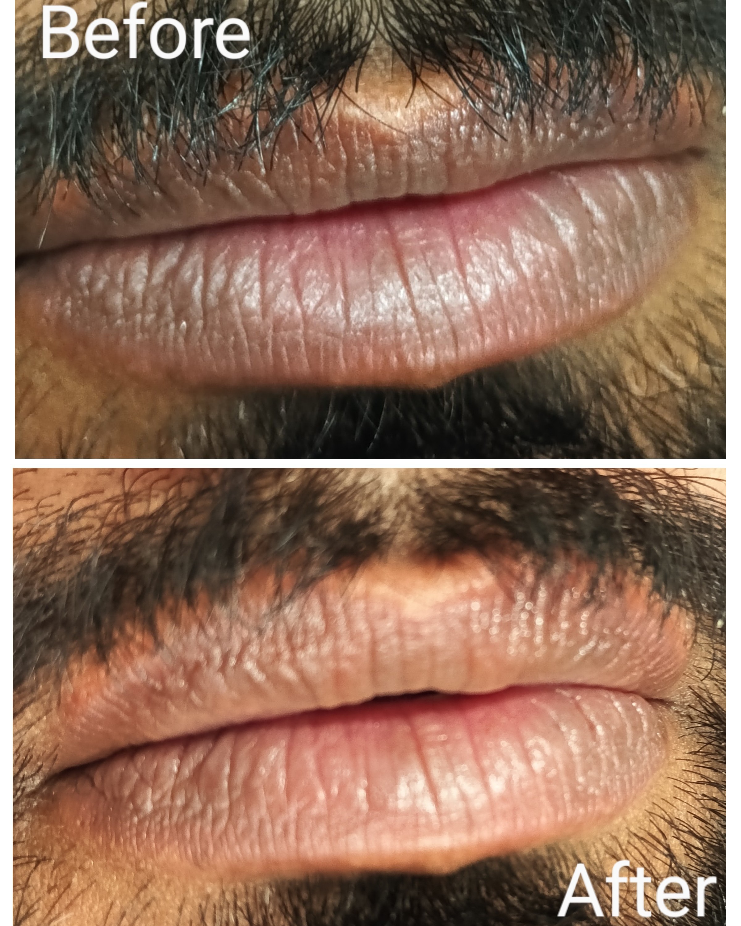 lip pigmentation treatment main image