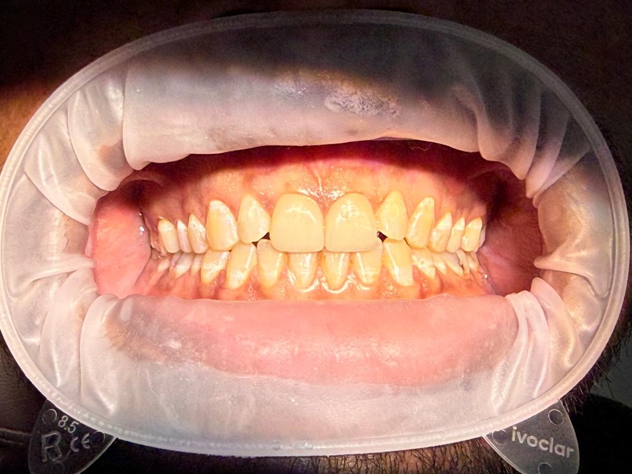 Smile Designing Treatment  main image
