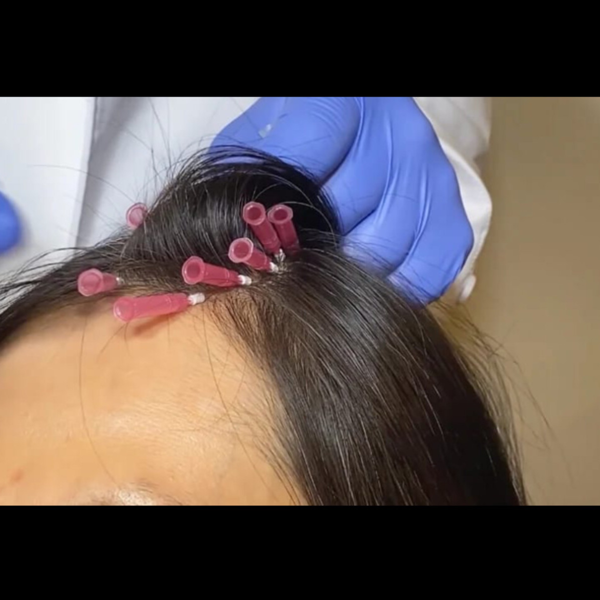 Hair Care Doctor Near Me In Salem Seelanaickenpatti  main image