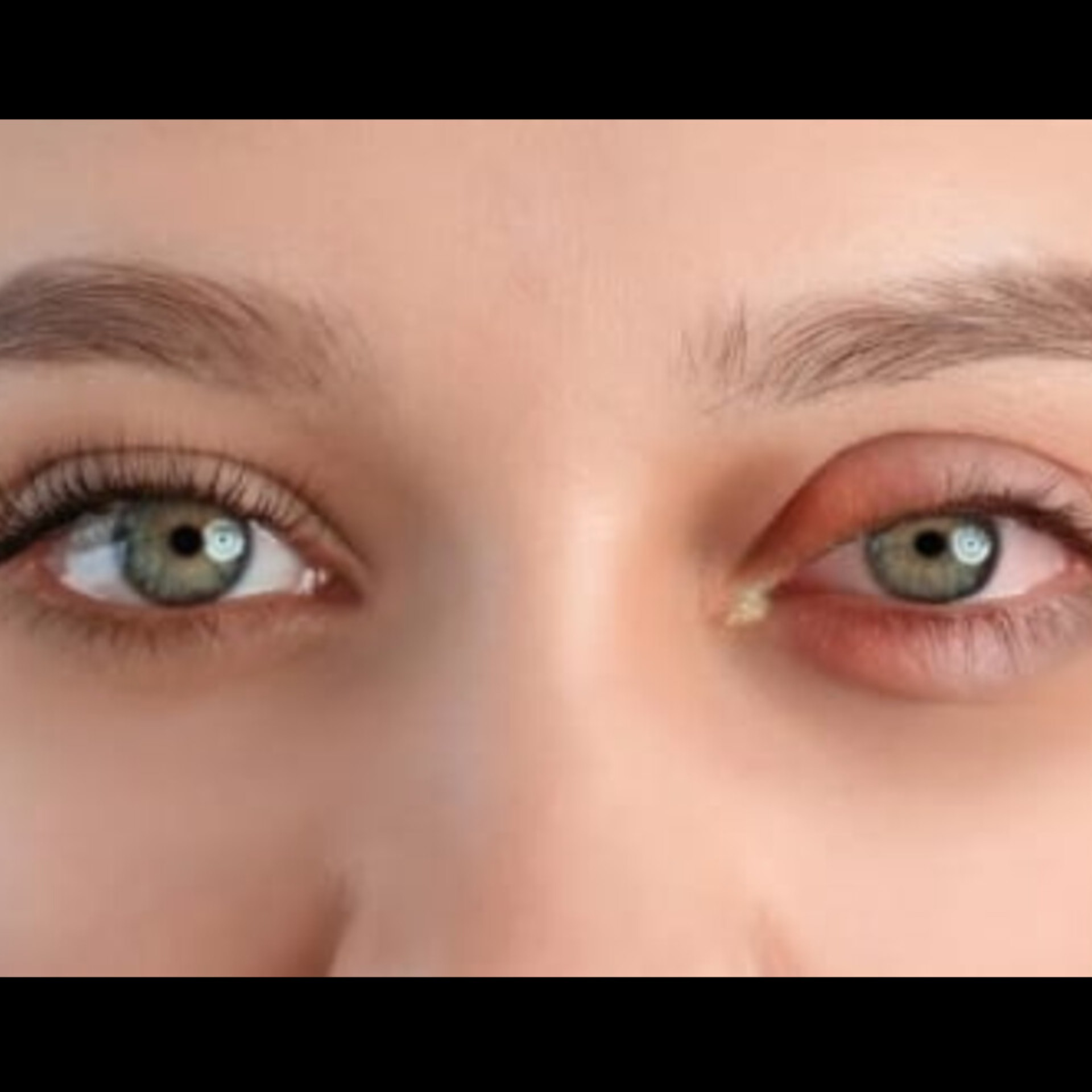Eye Doctor Near Me In Salem Seelanaickenpatti  main image