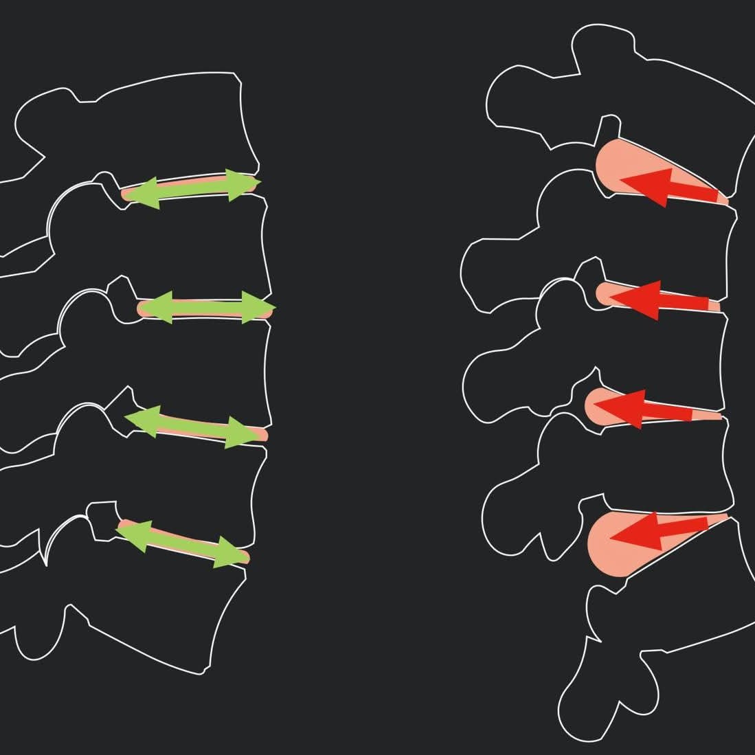 DISC DEGENERATION TO HERNIATION treatment at Sunshine Super Speciality Physiotherapy Clinic main image