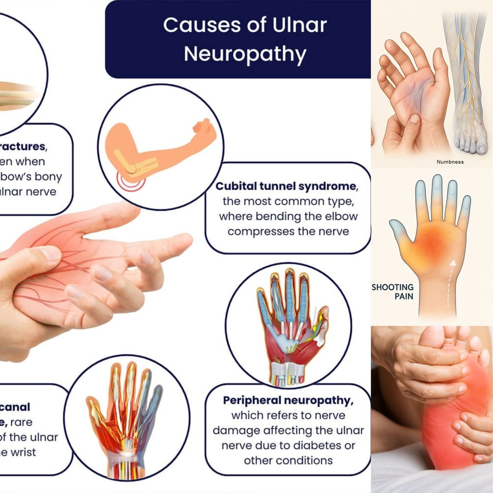 Cubital Tunnel Syndrome treatment at Sunshine Super Speciality Physiotherapy Clinic main image