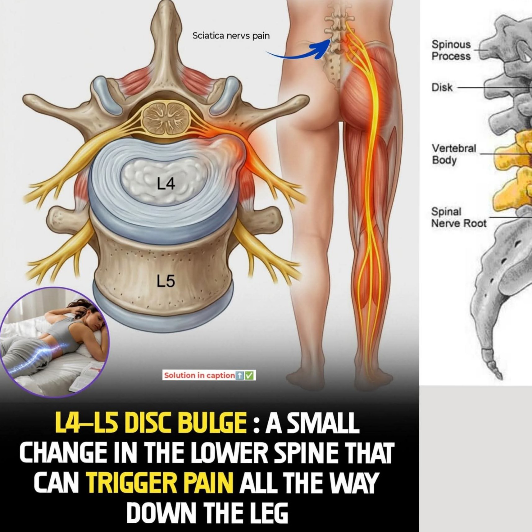LUMBAR DISC BULGE and Physiotherapy treatment at Sunshine Super Speciality Physiotherapy Clinic main image