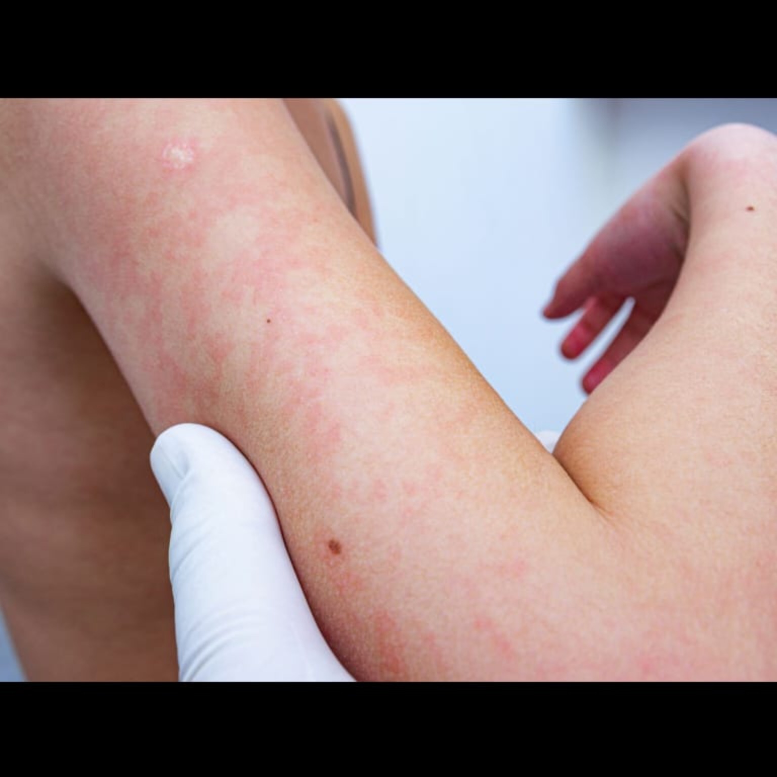 Dermatology Near Me In Salem Seelanaickenpatti  main image