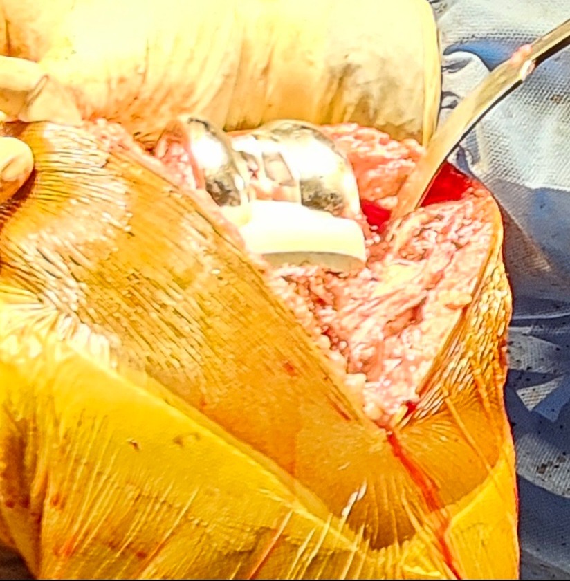 Knee Joint Replacement in Chennai – A Life-Changing Surgery for Mobility main image