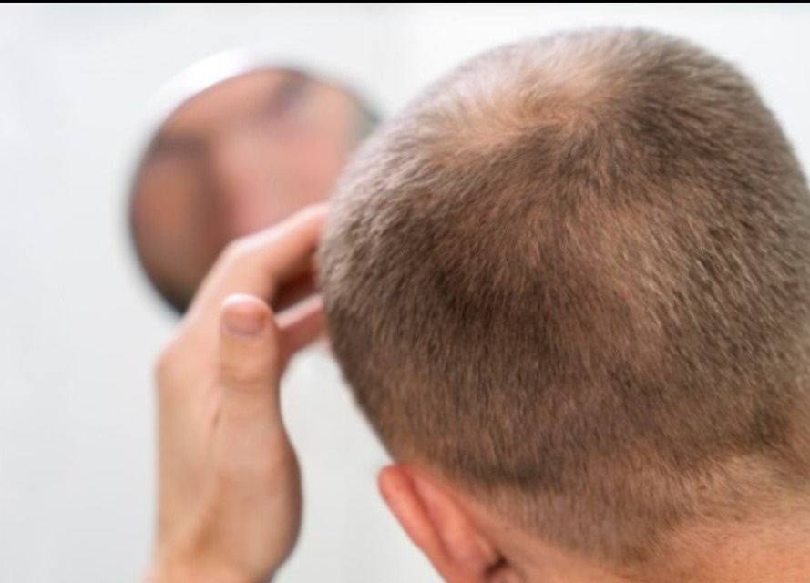Best Hair Loss Treatment in Chennai – A Structured Approach That Works main image