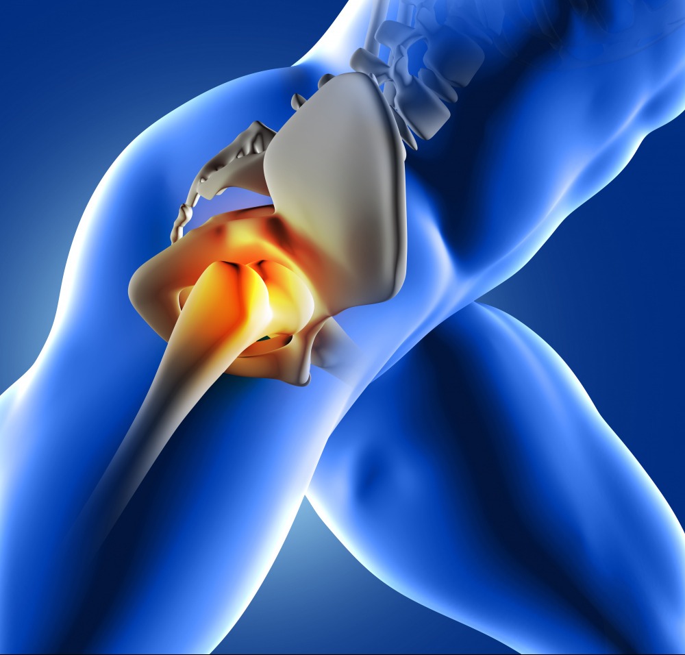 Hemi Hip Arthroplasty in Chennai – A Minimally Invasive Option main image