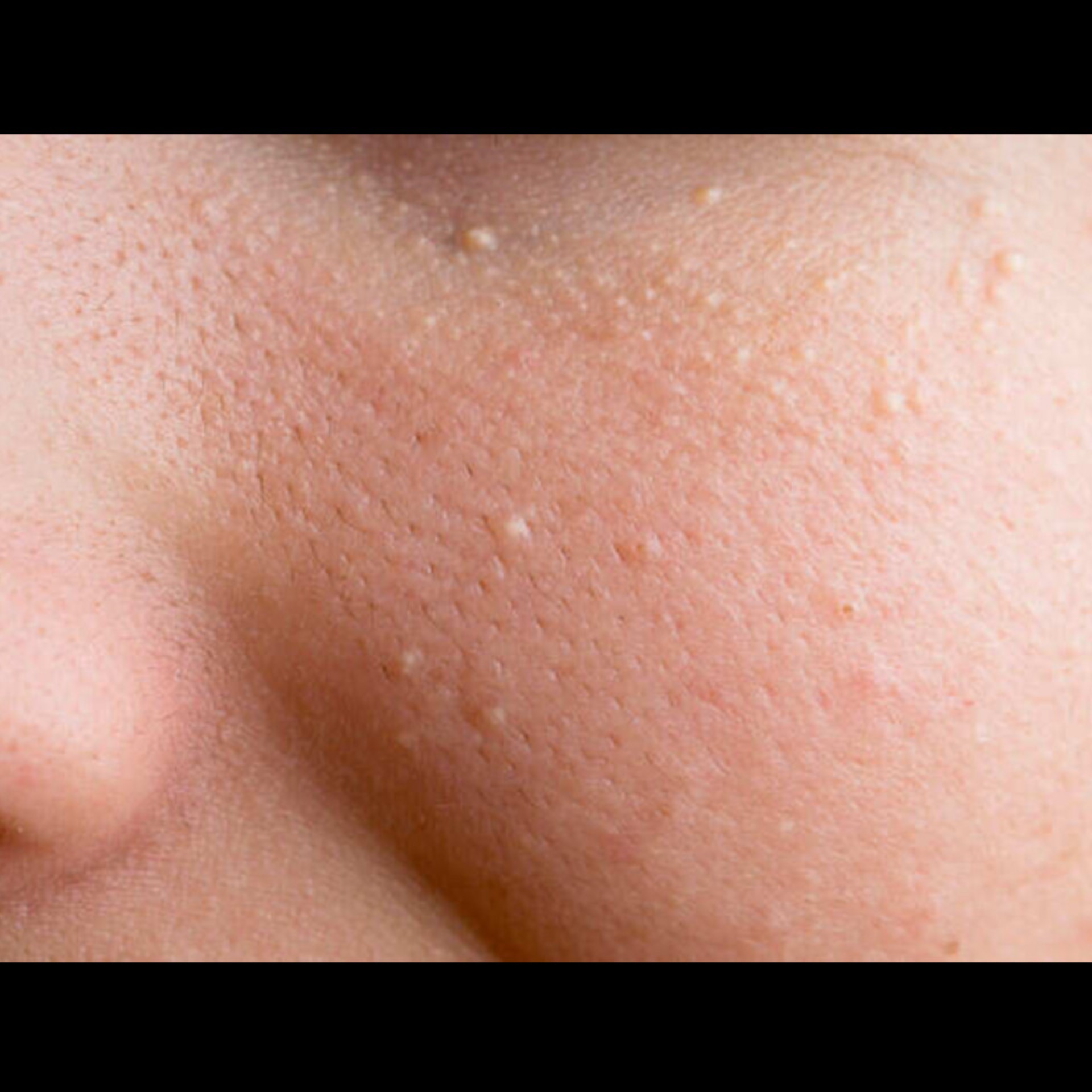 Dermatology Near Me In Salem Seelanaickenpatti  main image