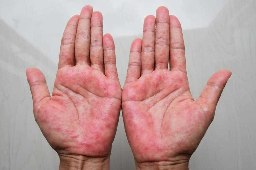 Dermatology Near Me In Salem Seelanaickenpatti  main image