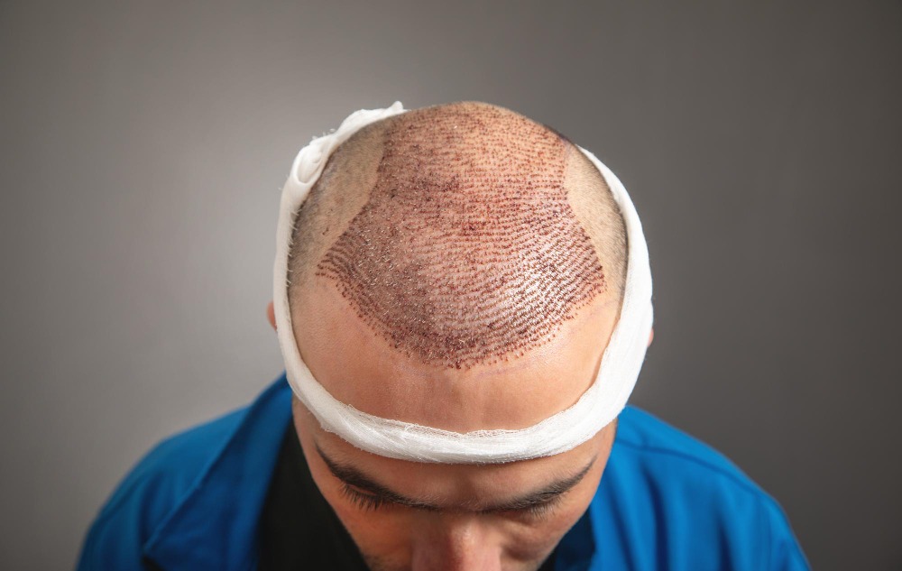 Hair Transplant Cost in Chennai – Looking Beyond the Numbers main image