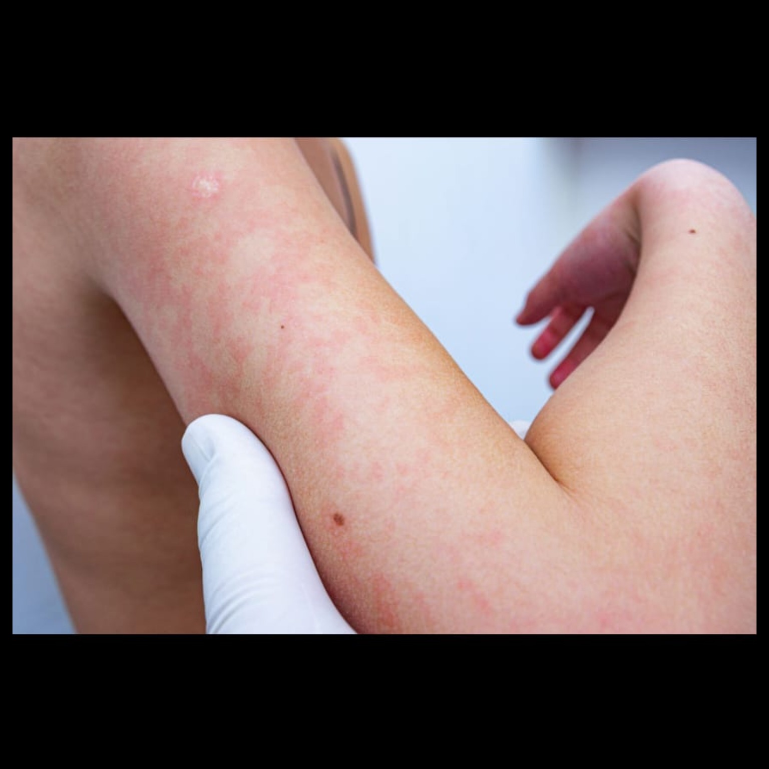 Skin Doctor Near Me In Salem Seelanaickenpatti  main image