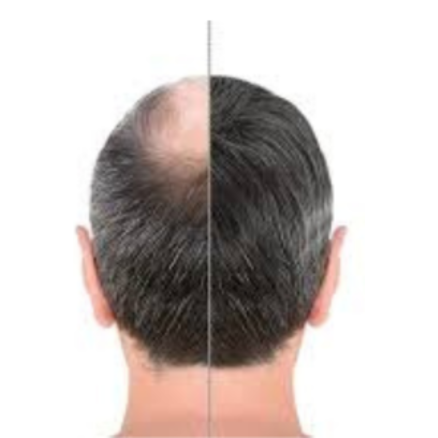 Best Hair Transplant in Chennai for Natural Hairline Restoration and Lasting Confidence main image