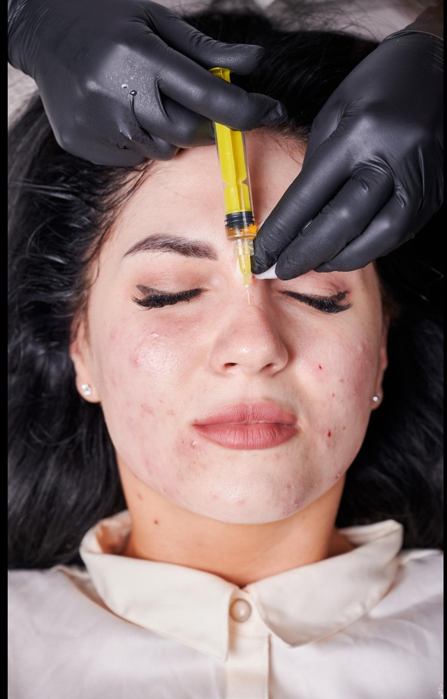 Acne Scar Treatment in Chennai for Noticeably Smoother and Healthier Looking Skin main image