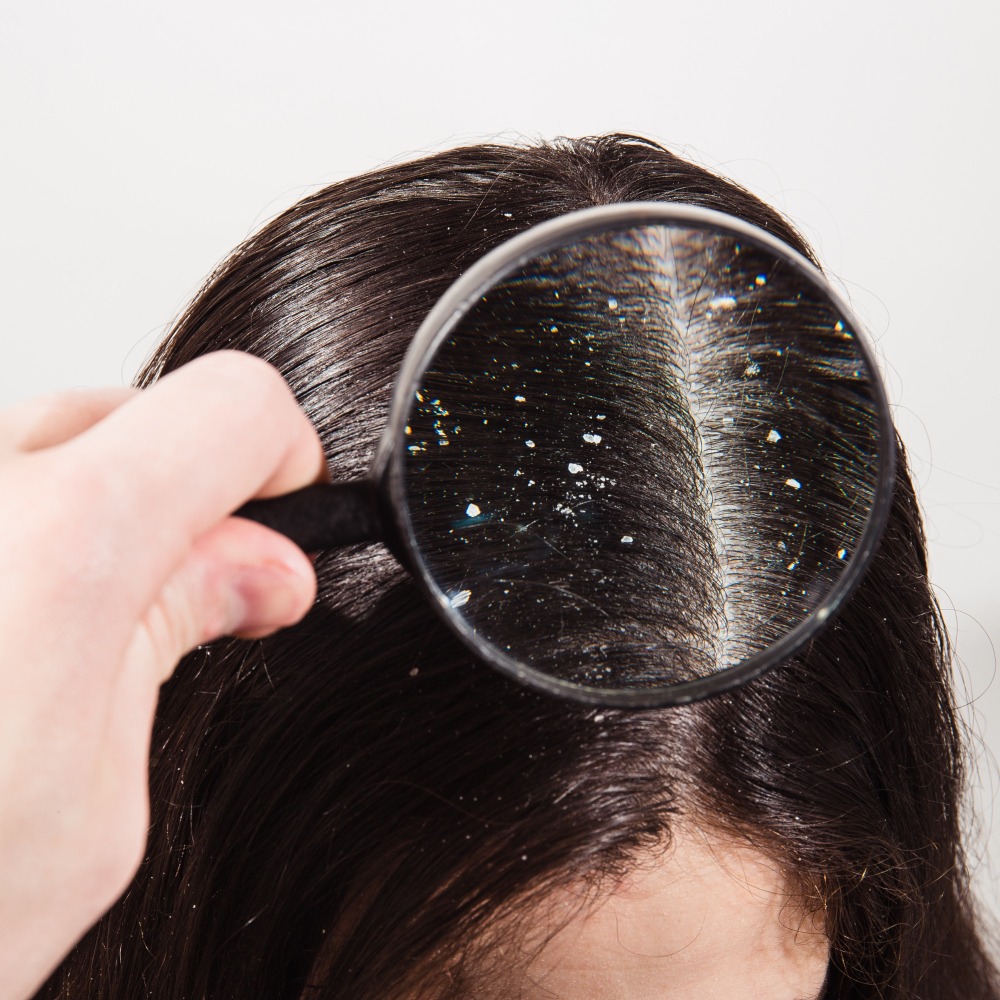 Dry Scalp Treatment in Chennai – Restoring Comfort and Balance main image