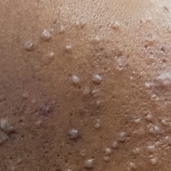 Vibha skin
