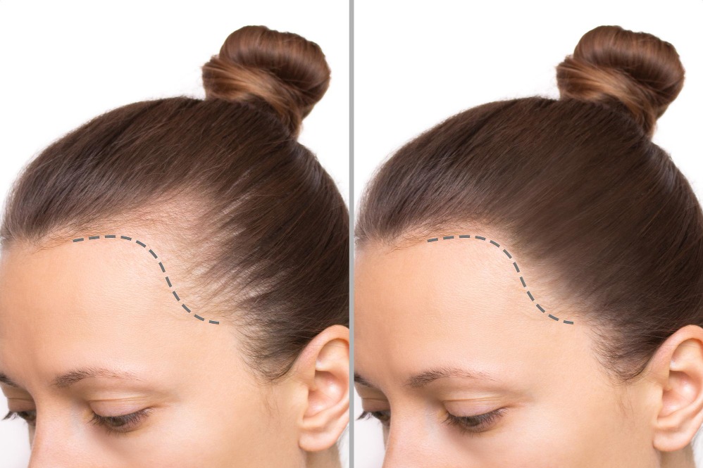Hair Transplant for Women in Alwarpet – Addressing Hair Thinning with Confidence main image