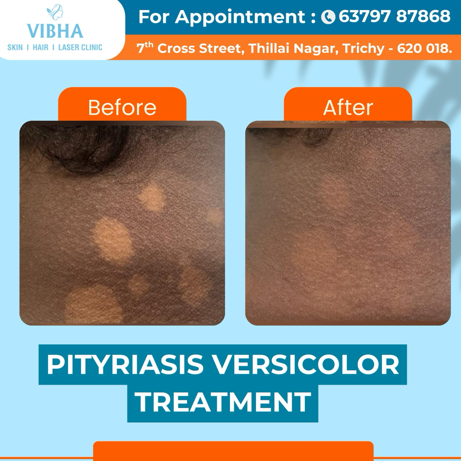 Vibha skin