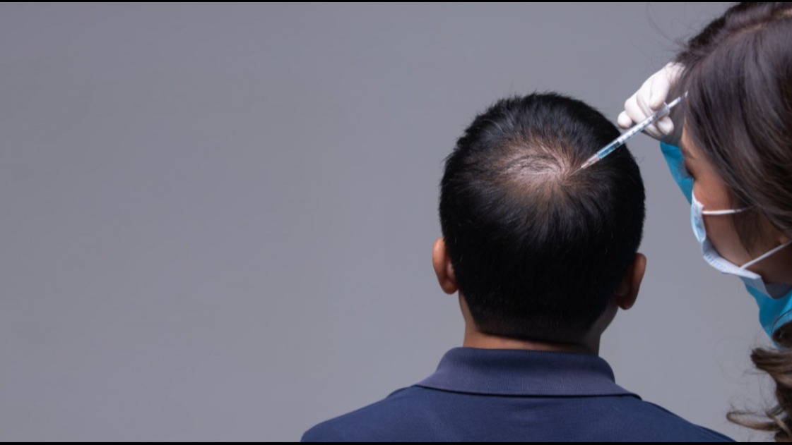 Hair Fall Treatment in Chennai – Targeted Solutions for Lasting Results main image