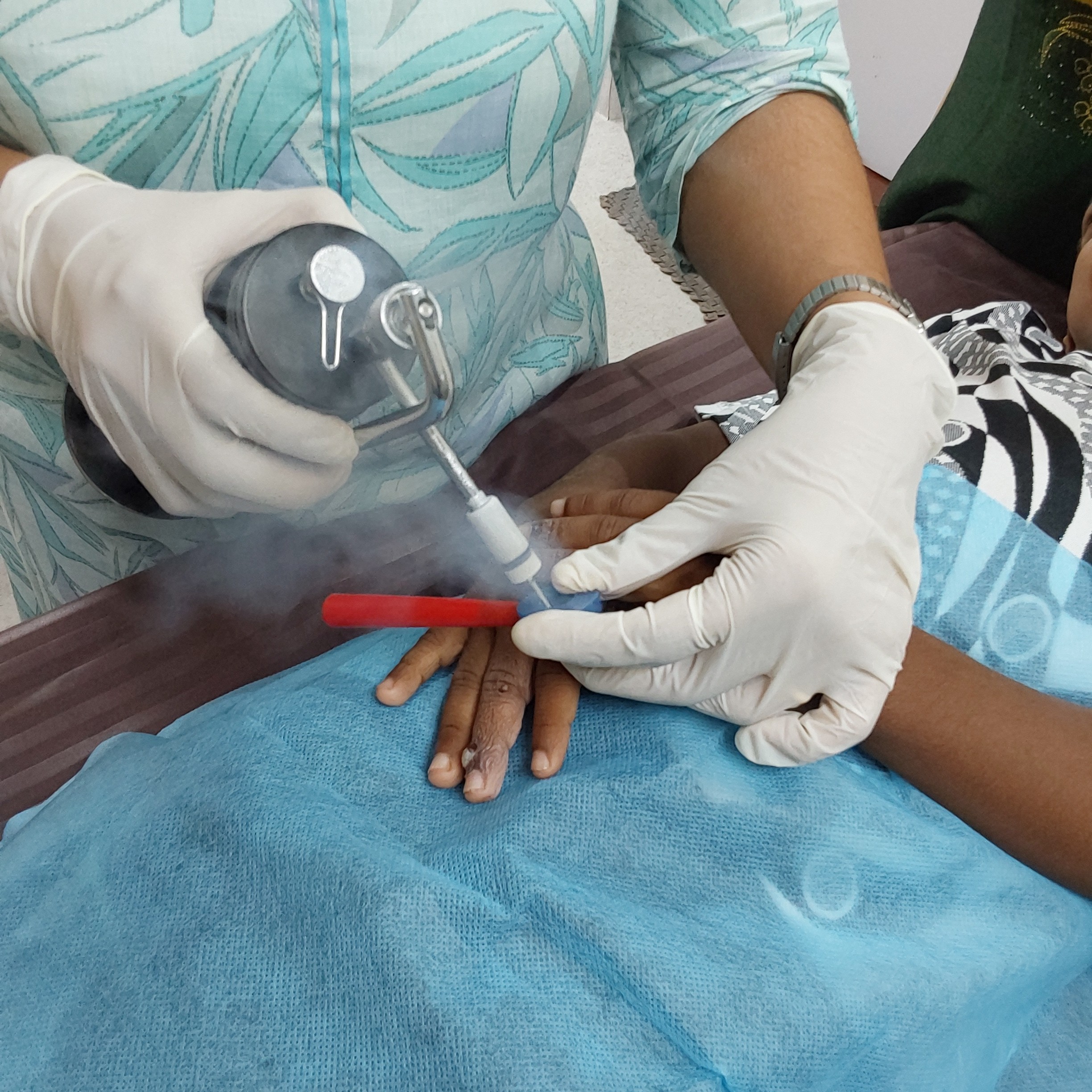 Best and affordable treatment for warts in Trichy main image